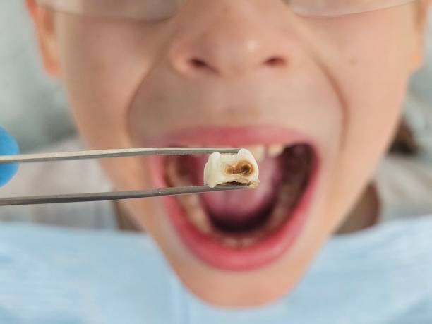 Best Emergency Dental Extractions in Glens Falls North, NY